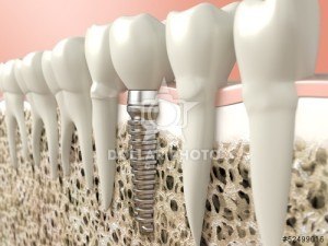 dental implant