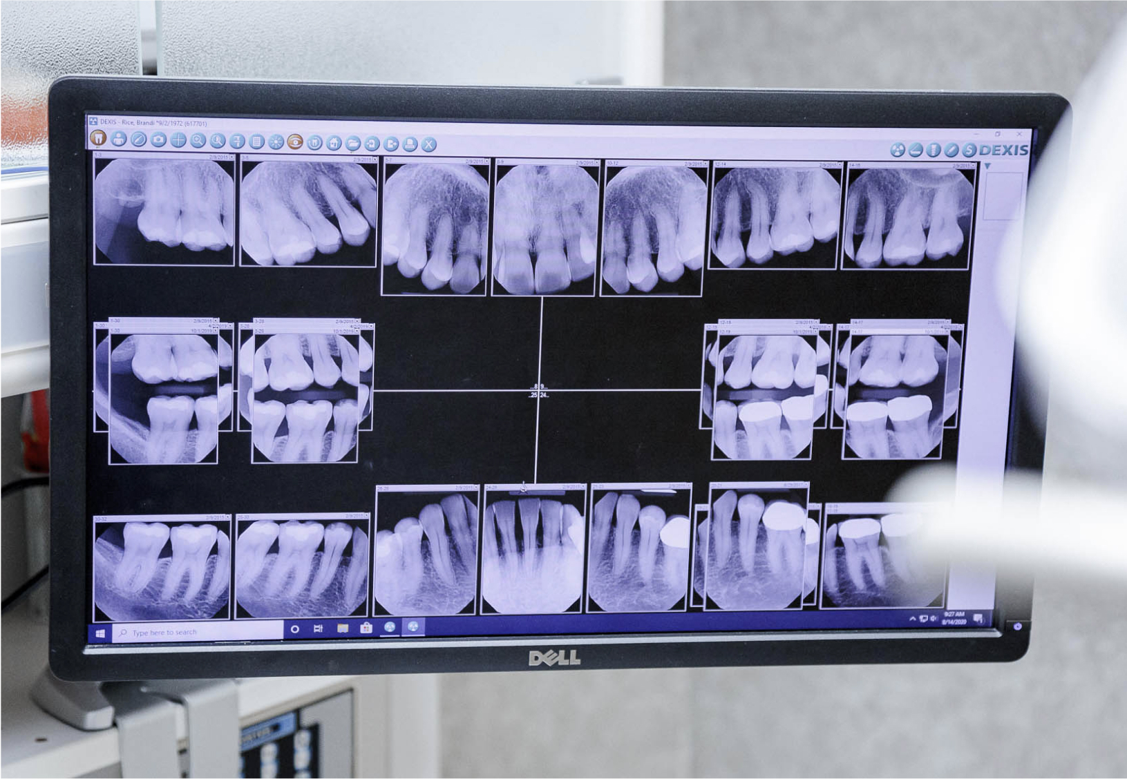 computer monitor with dental x-ray image